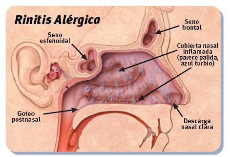 Rinitis Alérgica Rinitis Alérgica