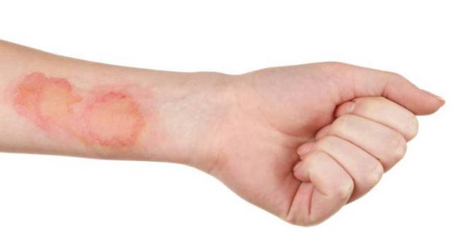 Cómo tratar y curar una quemadura Cómo tratar y curar una quemadura