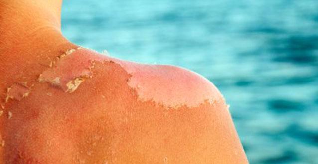 quemaduras solares quemaduras solares