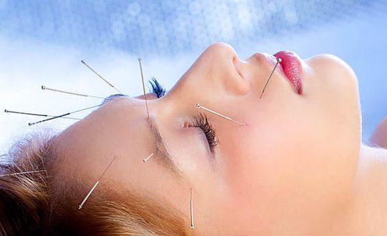 Acupuntura migraña