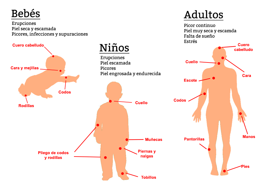 Síntomas de la piel atópica