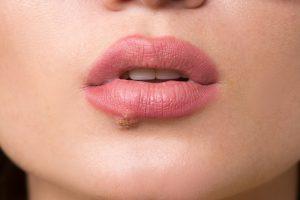 herpes labial