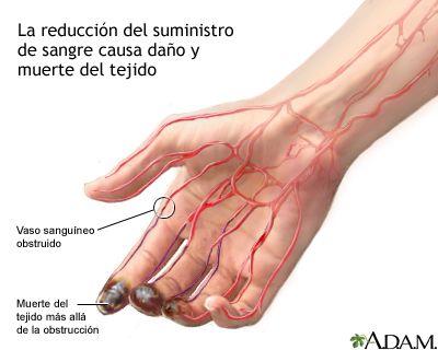 síndrome de raynaud - dedos