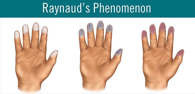 fenómeno raynaud