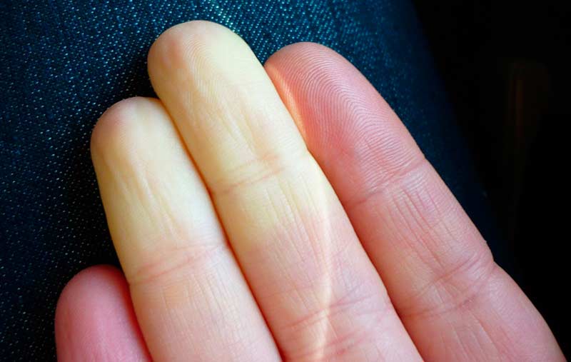 Síndrome de Raynaud