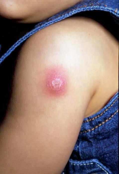 reacciones adversas vacunas