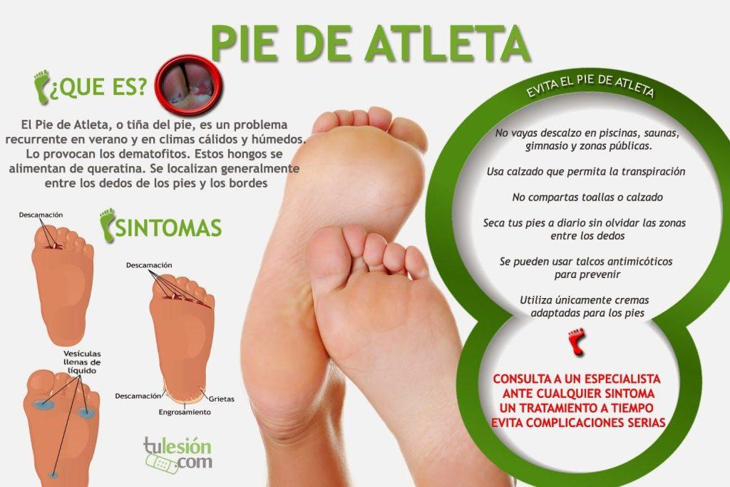 consejos pie de atleta