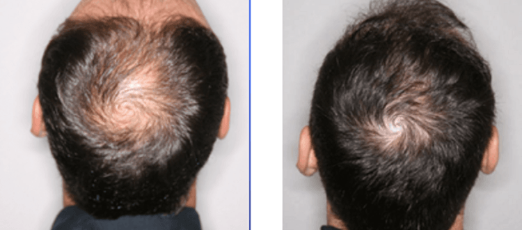 regla tsunami Abuso Minoxidil para la caída del cabello