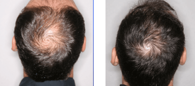 minoxidil para la caida del cabello