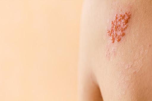Herpes Zóster (Culebrilla): causas, síntomas y tratamiento