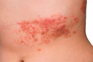 herpes zoster herpes zoster